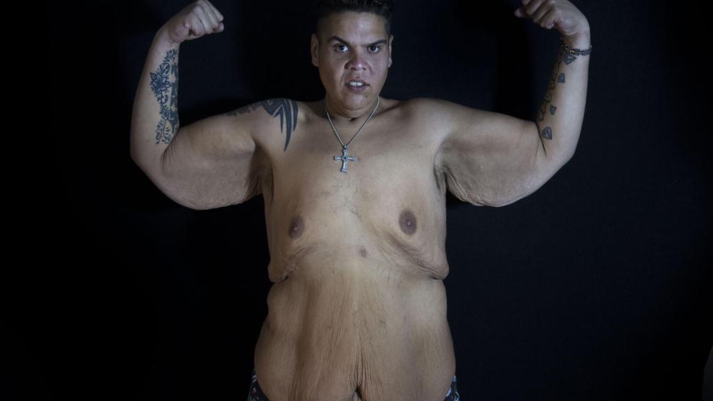 Juan Manuel Heredia llegó a pesar 307 kilos, lo que lo convirtió en la persona más obesa de España.