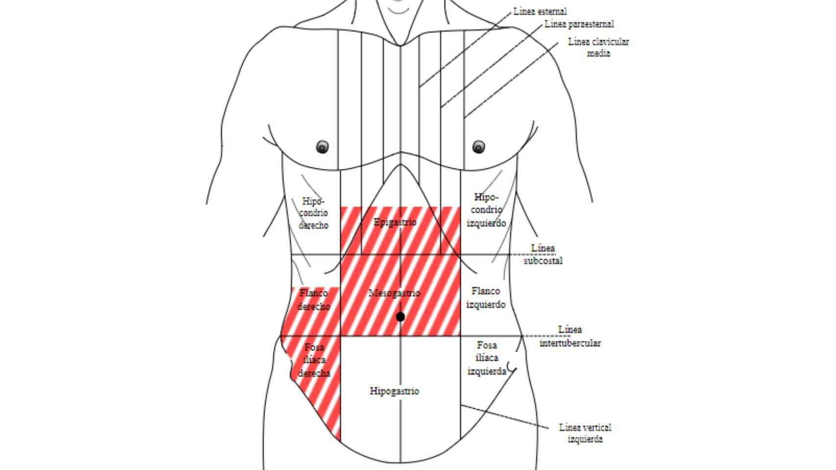 Las zonas en las que un dolor puede indicar una apendicitis.