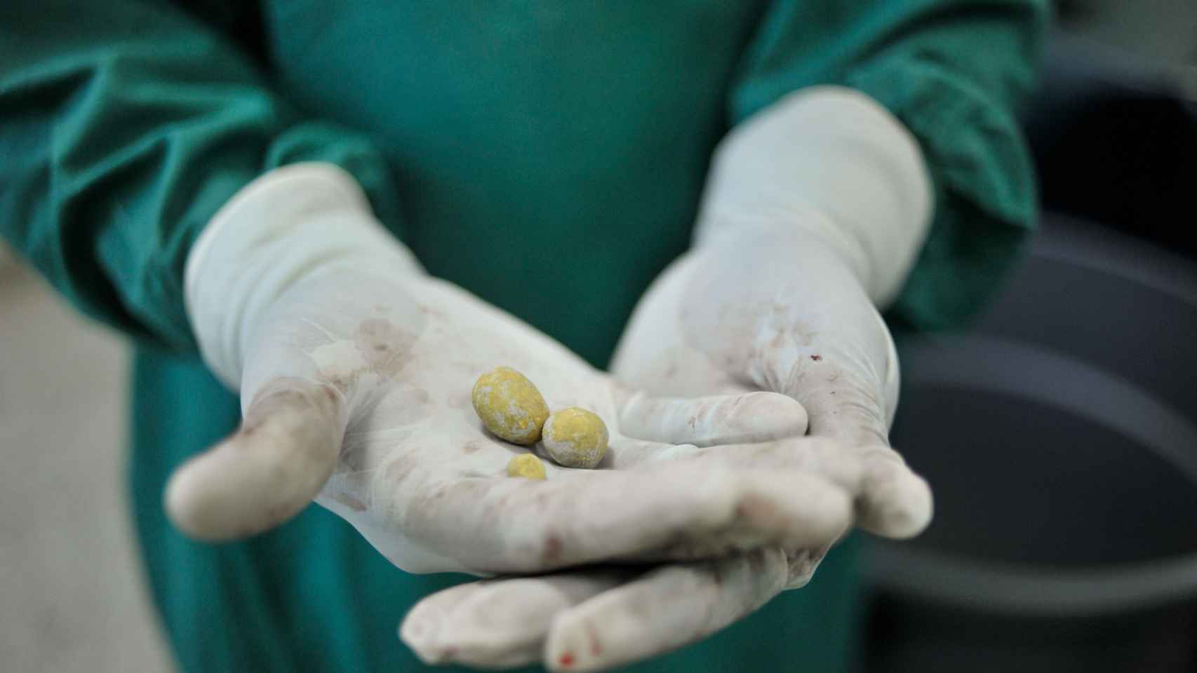 Dos piedras extraídas de la vejiga de un paciente con dolencias.