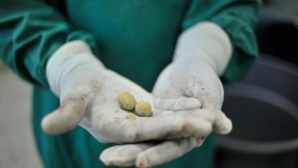 Dos piedras extraídas de la vejiga de un paciente con dolencias.