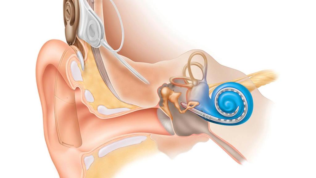Ilustración del mecanismo del implante coclear.