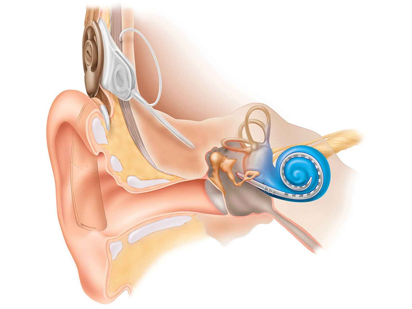 Aprobado un implante de conducción ósea para niños con sordera