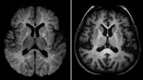 Un cerebro humano visto a través de una resonancia magnética.