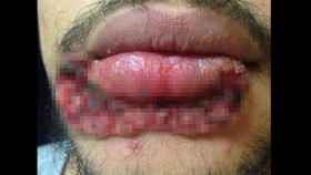 Aspecto de la blastomicosis en torno a la boca del paciente.
