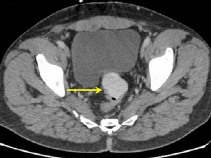 Radiografía que muestra la perforación en el intestino grueso.