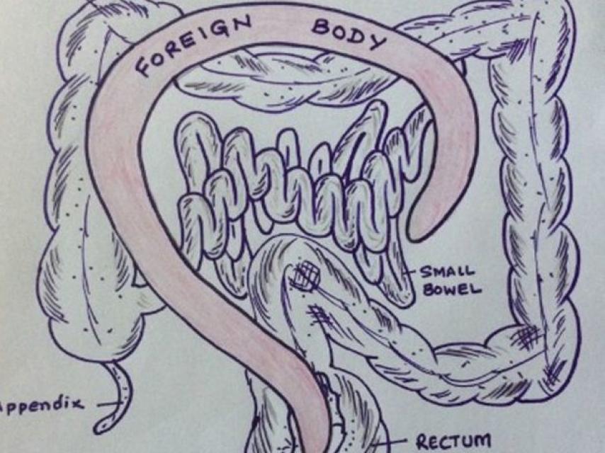 Dibujo de cómo atravesó el objeto el intestino grueso y casi alcanzó el diafragma.