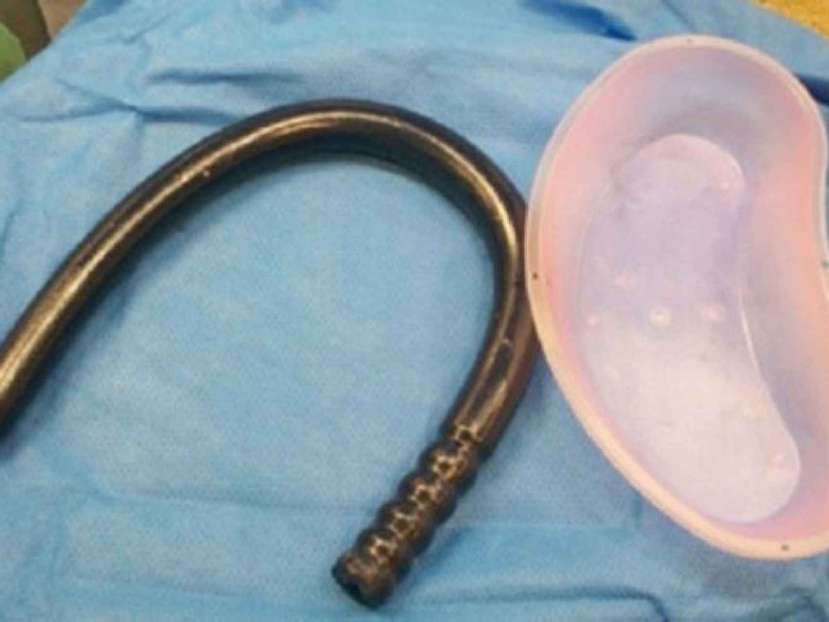 Perfora su intestino después de introducirse un objeto de 77 cm por el ano