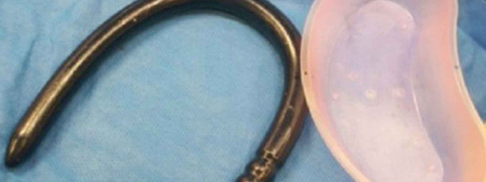 Perfora su intestino después de introducirse un objeto de 77 cm por el ano