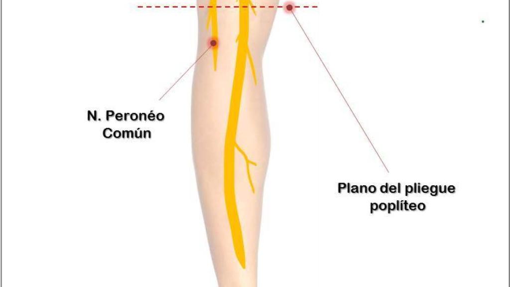 Esquema del nervio ciático