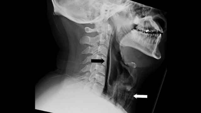 Las lesiones y la entrada de aire en la garganta del paciente.