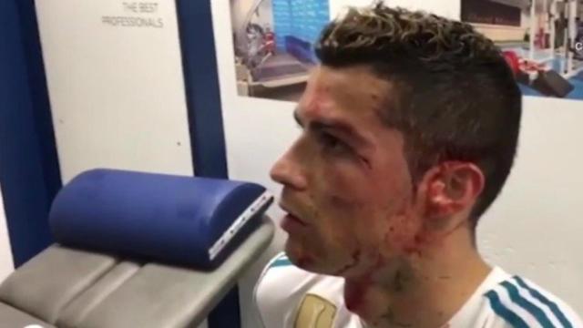 Herida de Cristiano Ronaldo tras el golpe en la cara contra el Dépor