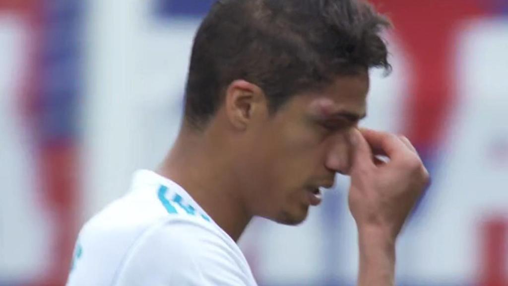 Raphael Varane, con un golpe en la cara