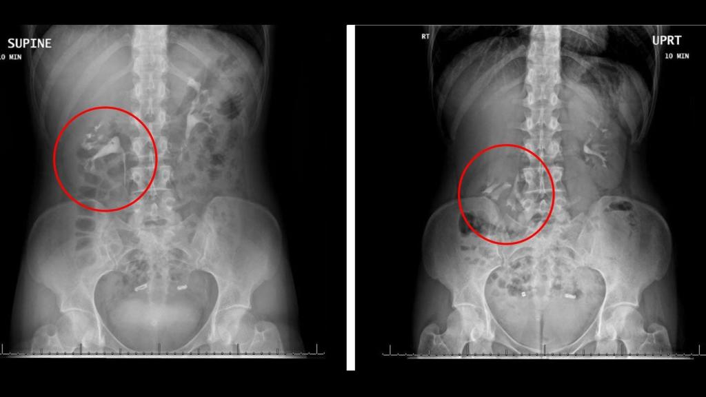 Entre la postura sentada y de pie, el riñón de la mujer se movió 5 cms.