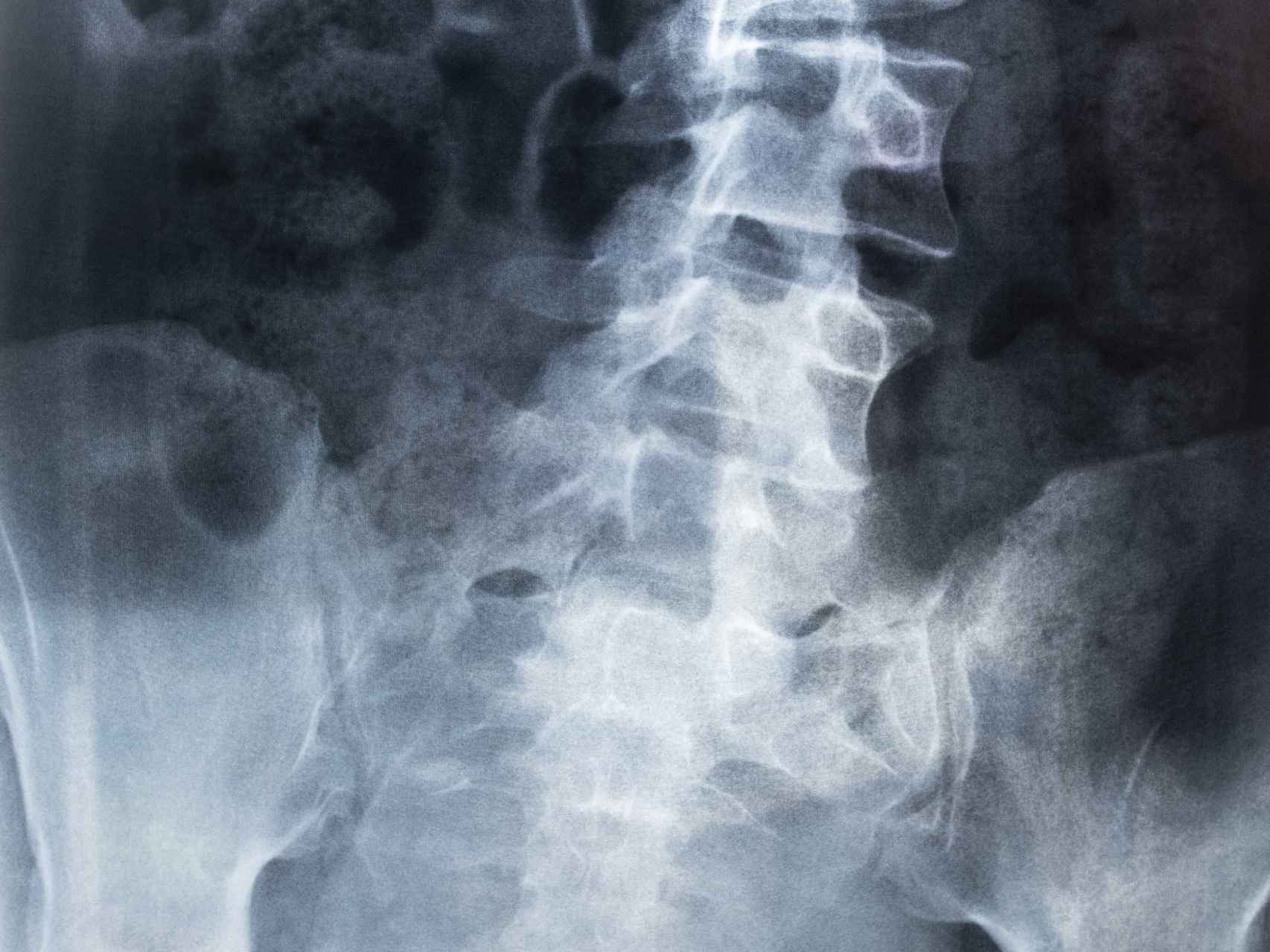 Radiografía de una espalda con escoliosis