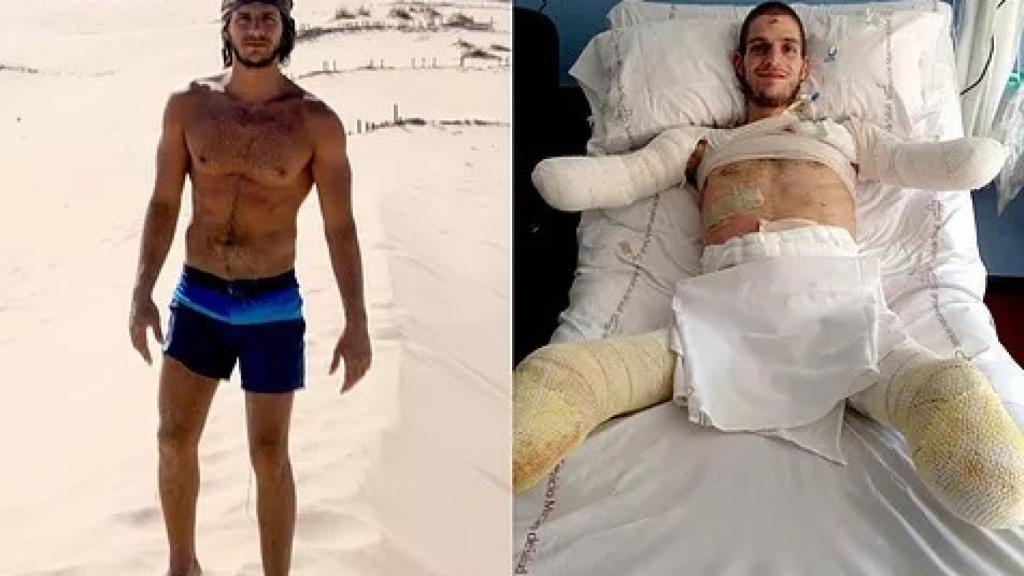 Davide Morana antes y después de la meningitis.