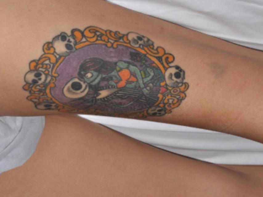 El tatuaje que provocó el dolor crónico.