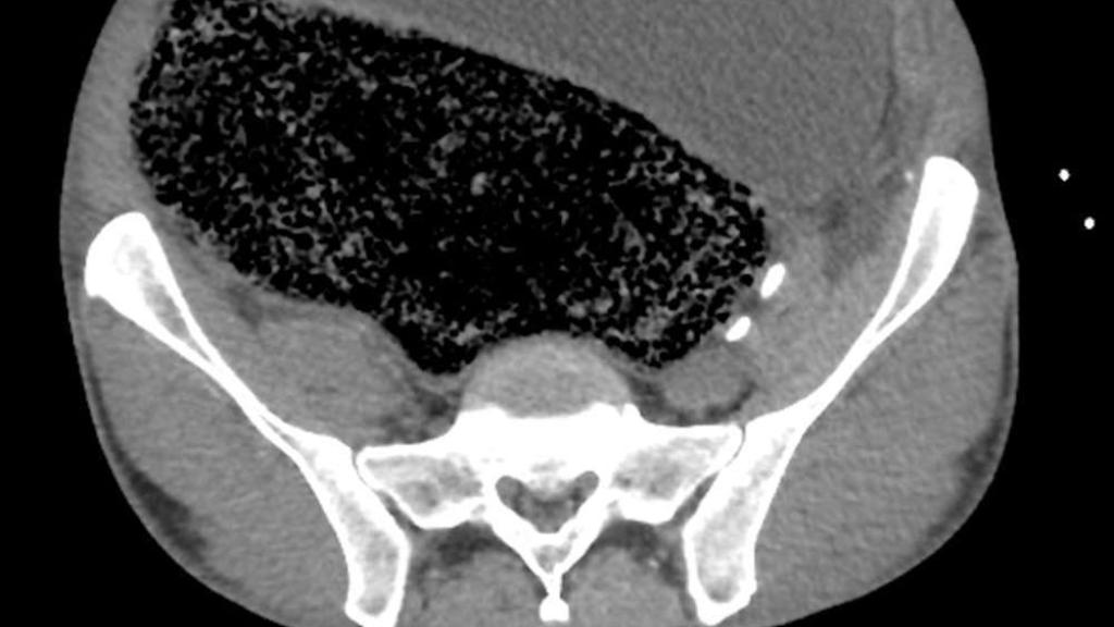 La masa fecal vista en el corte longitudinal, y la presión sobre las arterias.