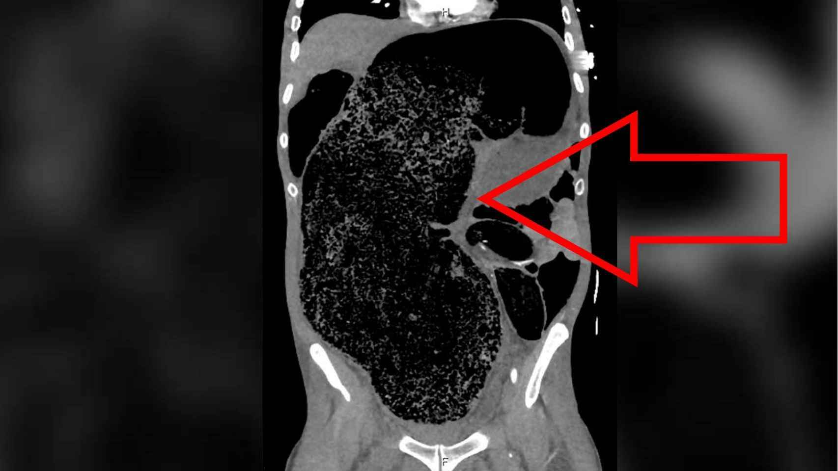 Imagen por escáner de la impactación fecal masiva que sufría el paciente en su abdomen.