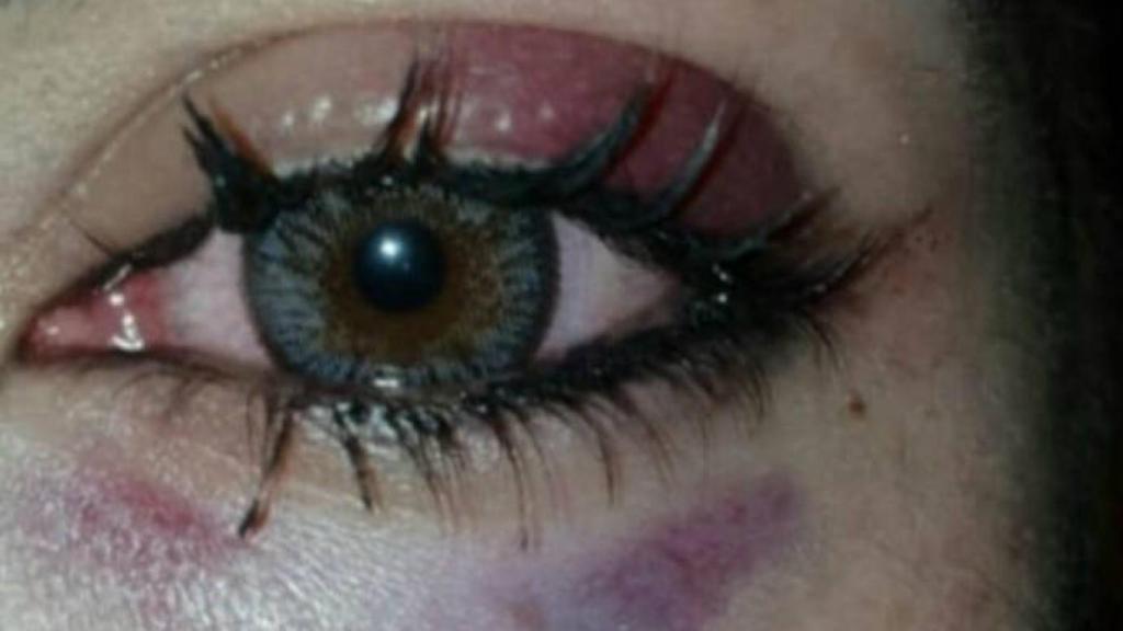 Así quedó el ojo de la joven agredida en Ciudad Real
