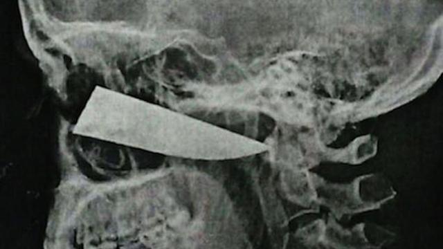 El cuchillo se mantuvo inmóvil atascado en un hueso bajo el ojo izquierdo