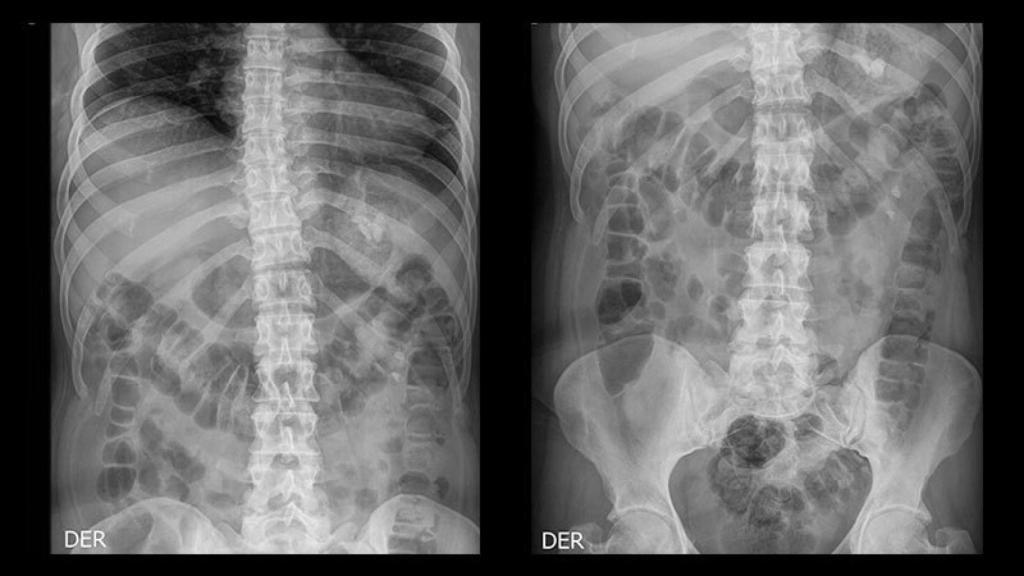 Una radiografía renal y vesical.