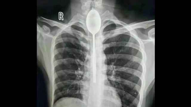 La radiografía con la cuchara alojada en el esófago del paciente.