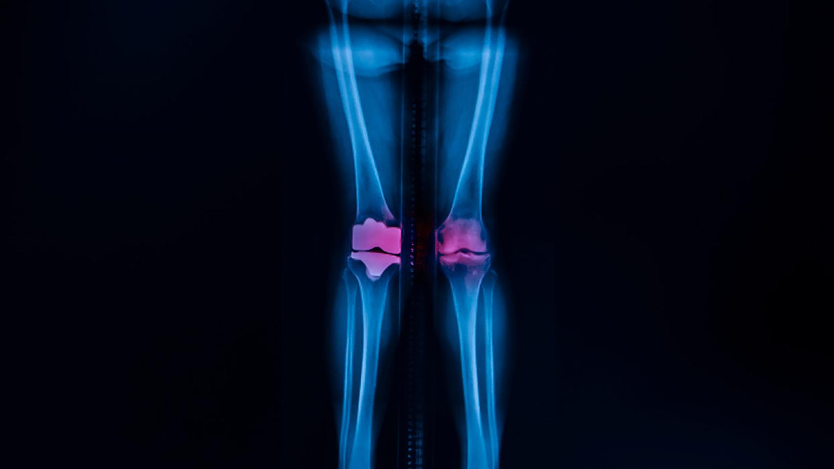 Este nuevo material mejorará las prótesis de rodilla y cadera.