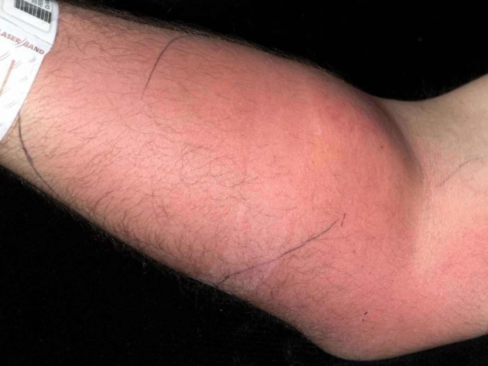 Un joven se inyecta su semen en el brazo para intentar curar su dolor de  espalda