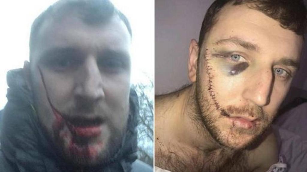 El hooligan del Everton agredido por ultras del Millwall