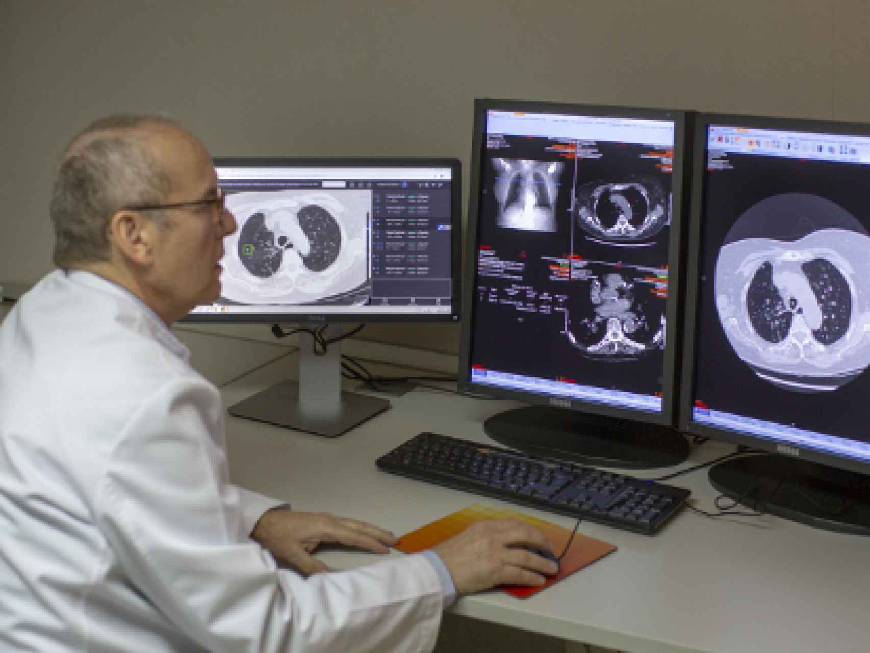 Inteligencia Artificial para detectar el cáncer de pulmón