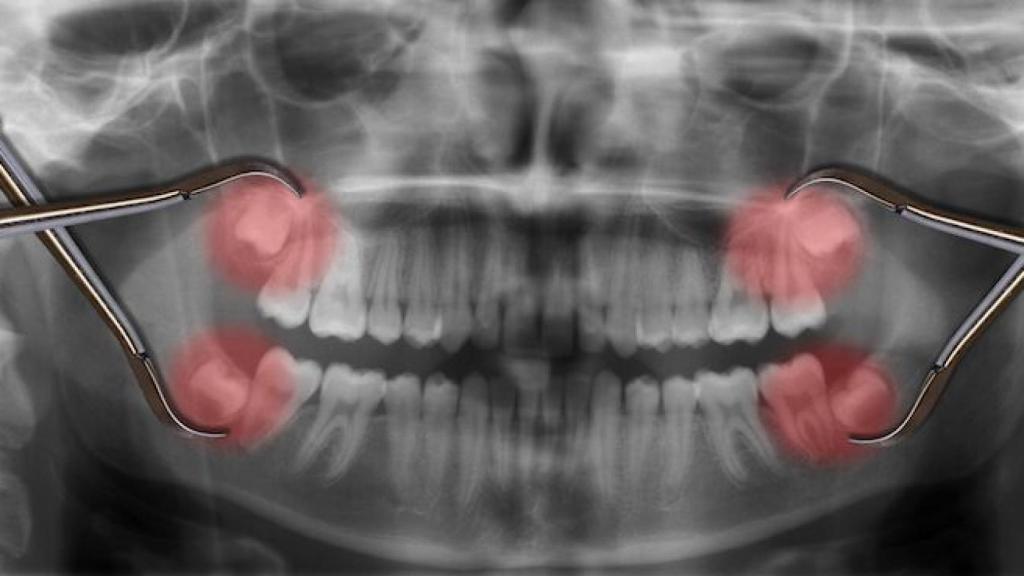 Representación en radiografía de la extracción de las muelas del juicio.