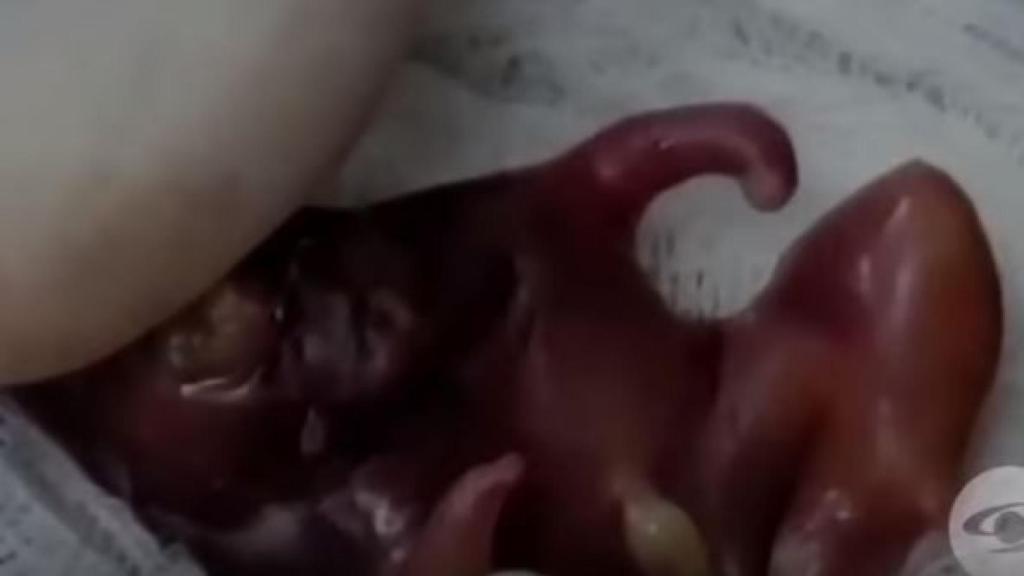 El feto extraído del bebé.