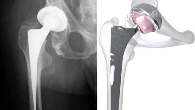 Radiografía de una prótesis en una cadera y un nuevo modelo de alta tecnología / Wikimedia commons.