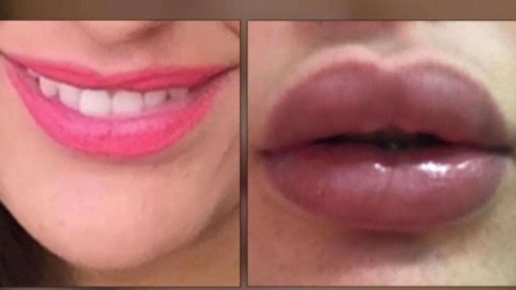 Labios de una de las víctimas antes y después de la operación. Foto: Las Palmas
