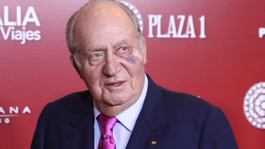 Juan Carlos I mostró unos claros hematomas el pasado 22 de marzo debido a la operación.