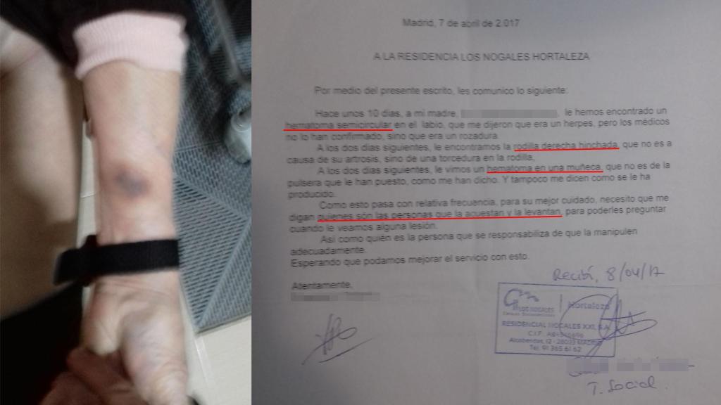 Uno de los hematomas que presentaba la madre de Francisco P., cuando era interna en Los Nogales.