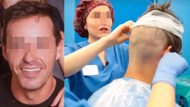 Rafael fue a ponerse implantes de pelo pero sufrió un infarto mortal durante la anestesia.