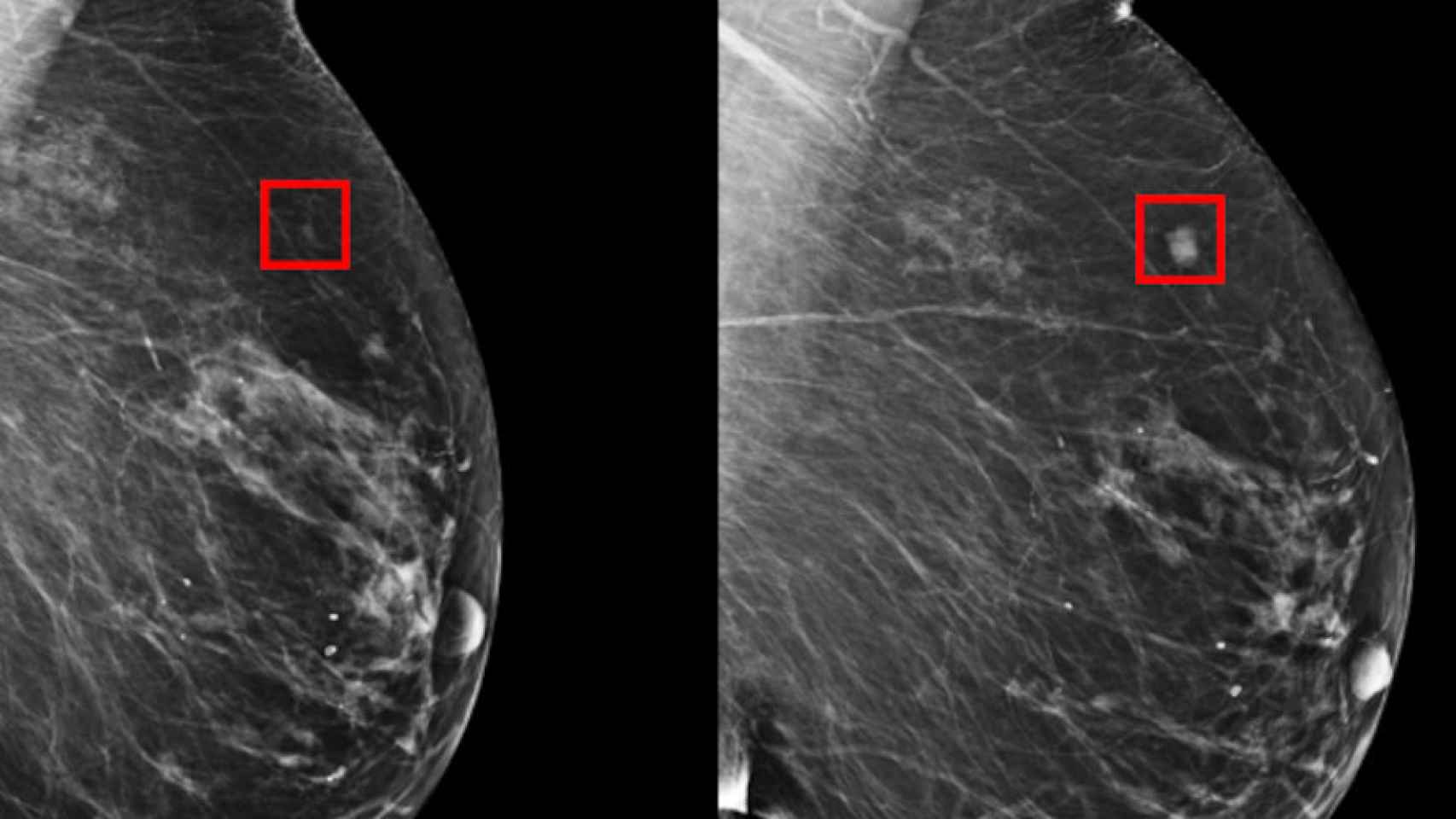 Resultados de una mamografía.