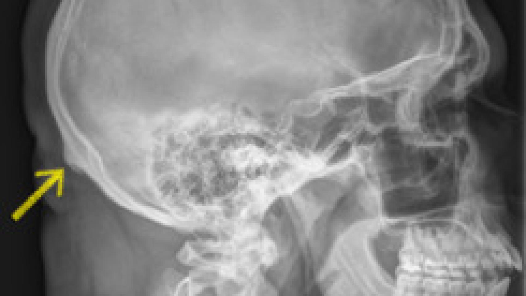 La protuberancia occipital externa es, de sobra, conocida por la ciencia.