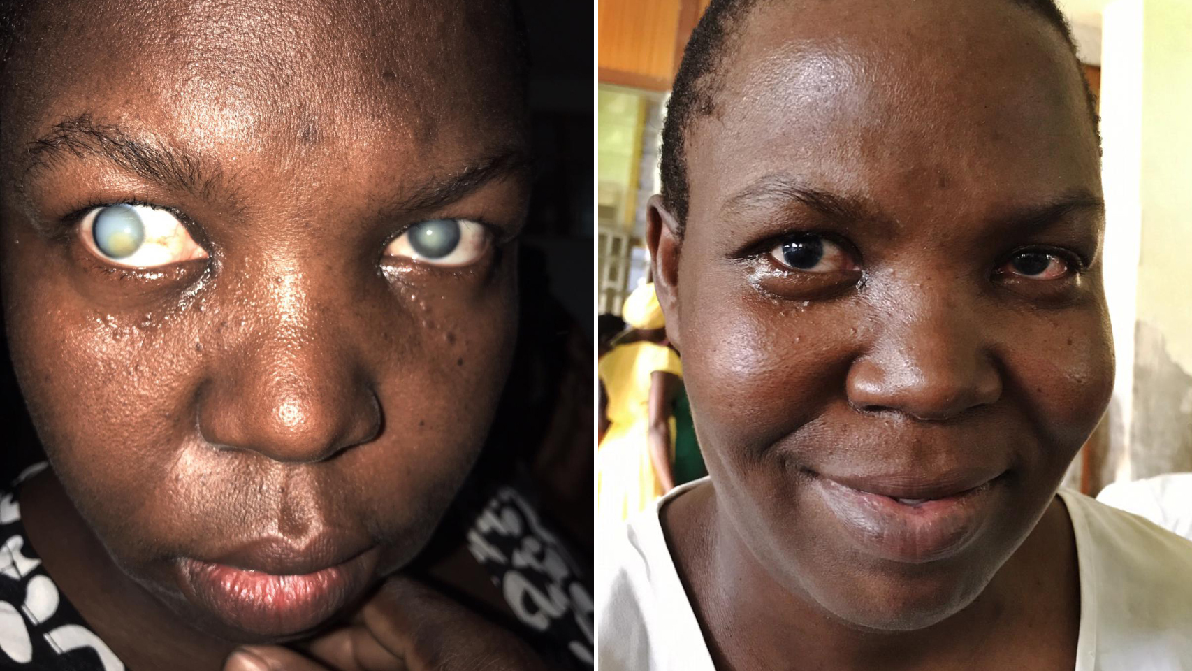 El antes y el después de Zaitu, tras su cirugía en los ojos.