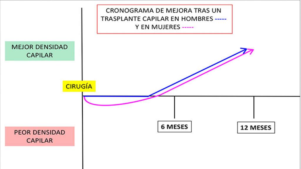 Diferencias de los implantes en hombres y mujeres.