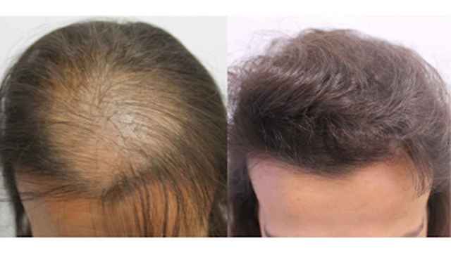 El 40% de las mujeres en España sufre alopecia y son el 30% de los clientes que se hacen operaciones de microinjertos.