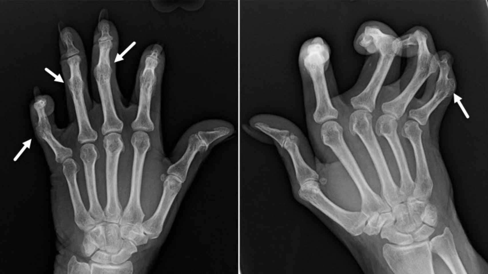 Radiografía de las manos de una enferma de artritis reumatoide. Learningradiology.com