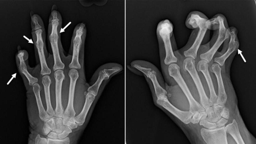 Radiografía de las manos de una enferma de artritis. Learningradiology.com