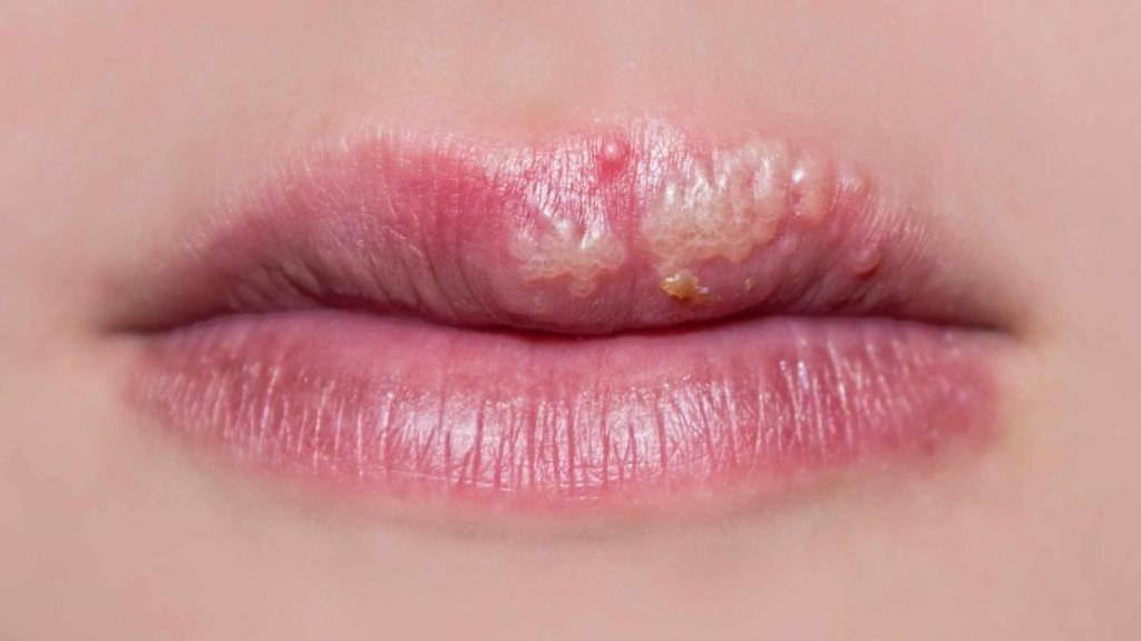 Una mujer afectada por un herpes labial.