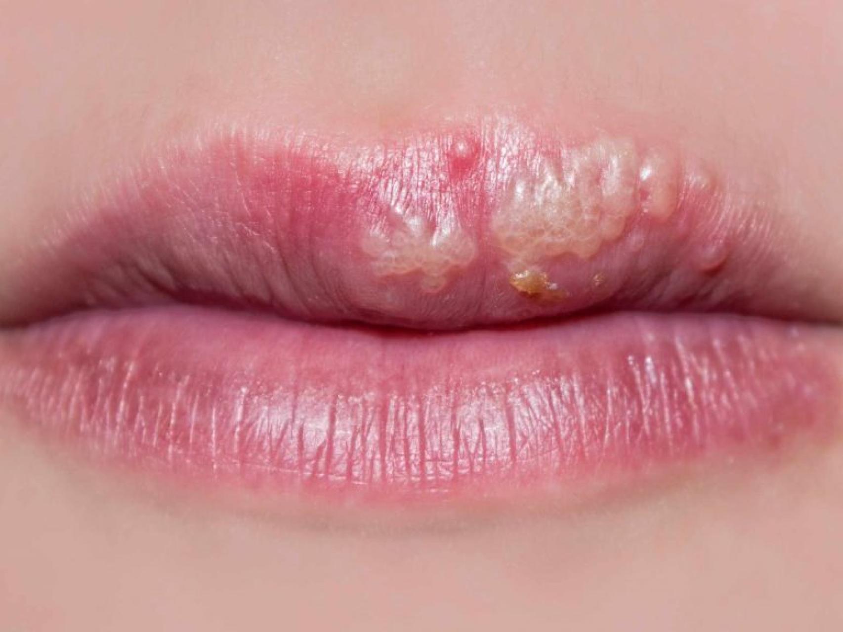 Herpes labial: estos son los productos que funcionan y los que no