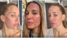 Carola Baleztena ha contado su experiencia con el láser facial ante sus seguidores.