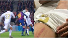 Así quedó el muslo de Varane tras la fuerte entrada de Lenglet en el penalti no pitado