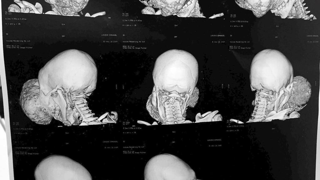 Un TAC con diferentes imágenes del tumor de Emmanuel antes de la intervención. EFE/Fundacion Pedro Cavadas