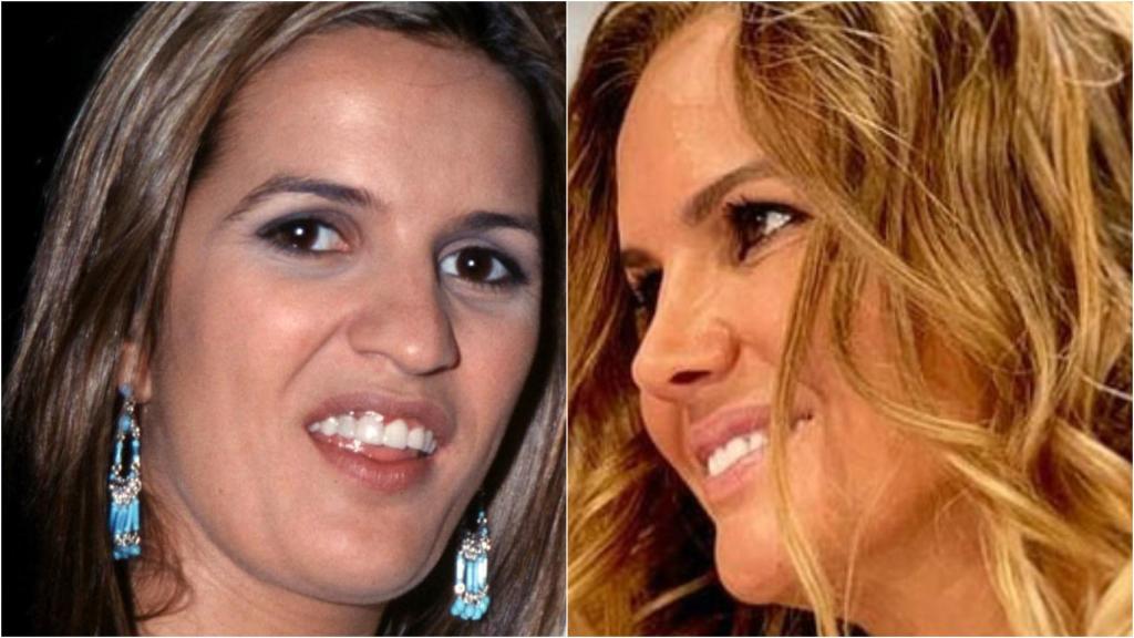 La nariz de Marta López, antes y después de su operación.